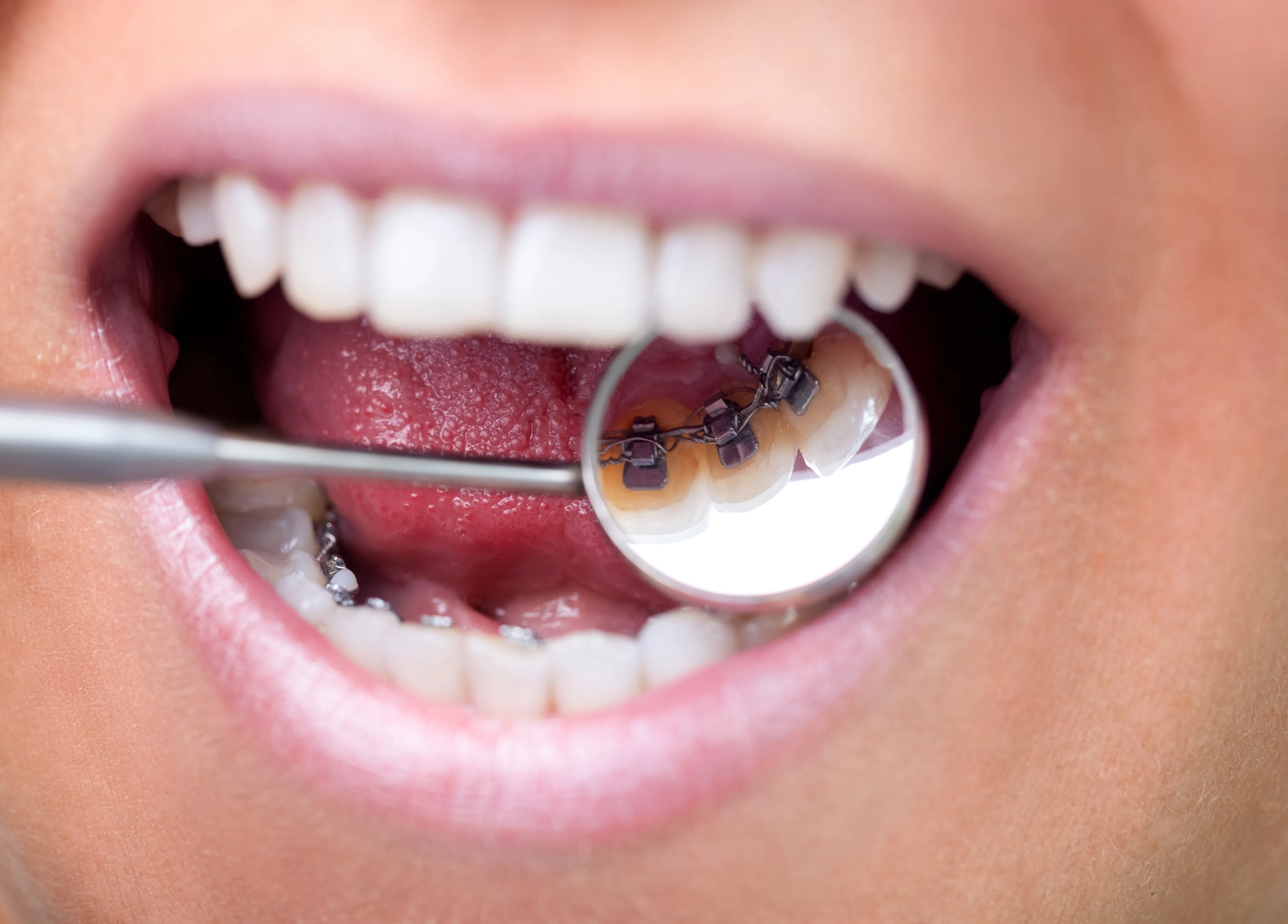 Full mouth reconstruction at Henderson and Goslee Family Dentistry