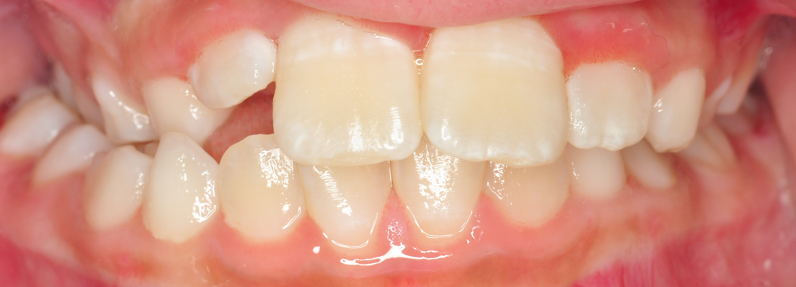 Orthodontics — before treatment