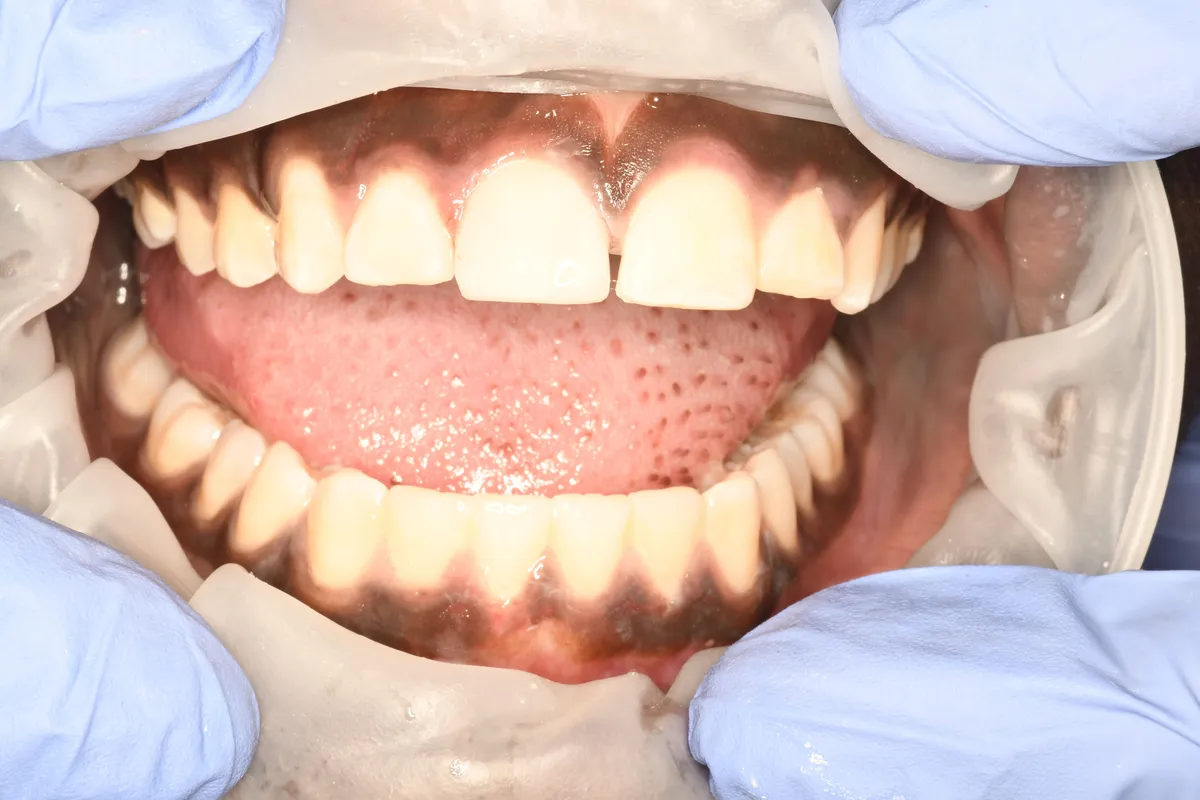 Dental Bonding — after treatment