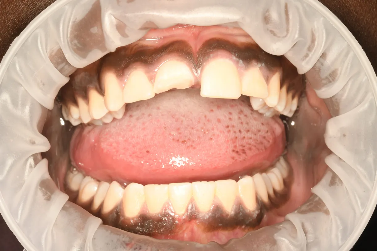 Dental Bonding — before treatment